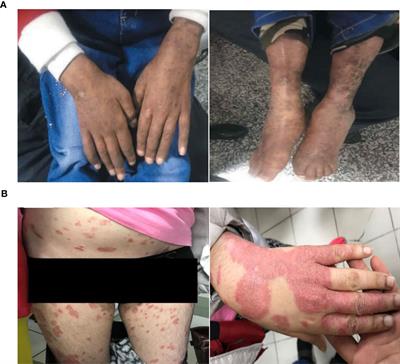 Atypical Ataxia Presentation in Variant Ataxia Telangiectasia: Iranian Case-Series and Review of the Literature